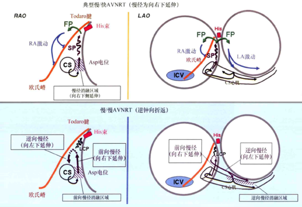 阵发性心房扑动吃什么药_阵发性室上性心动过扑_阵发心房扑动